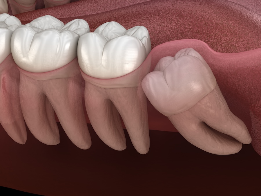 Wisdom Teeth Removal Near Richmond, TX: Signs It’s Time to Schedule and What Recovery Looks Like