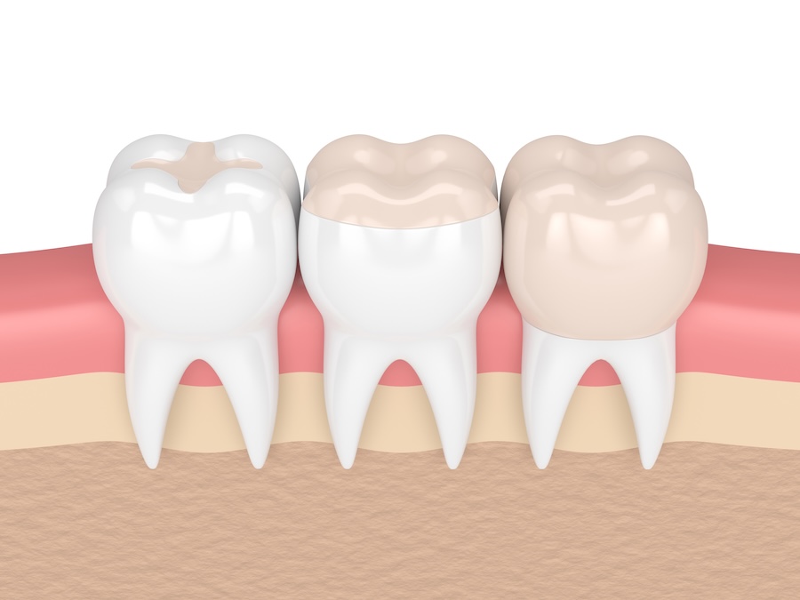 Dental Crowns vs. Fillings in Richmond, TX