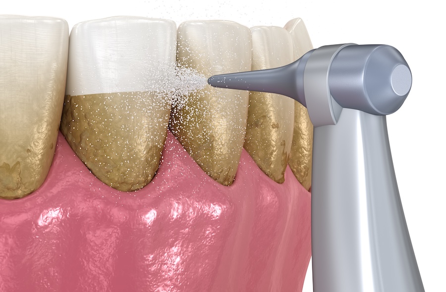 Why More Patients in Richmond Are Choosing Guided Biofilm Therapy Over Traditional Dental Cleanings
